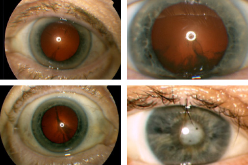 stages_of_cataract_development